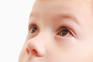 Child conjunctivitis red eye with infection, illness.